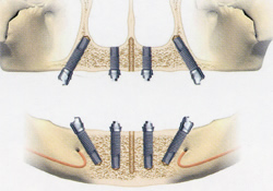 オールオン４ すべての歯を4カ所で固定 安藤歯科orcインプラントクリニック